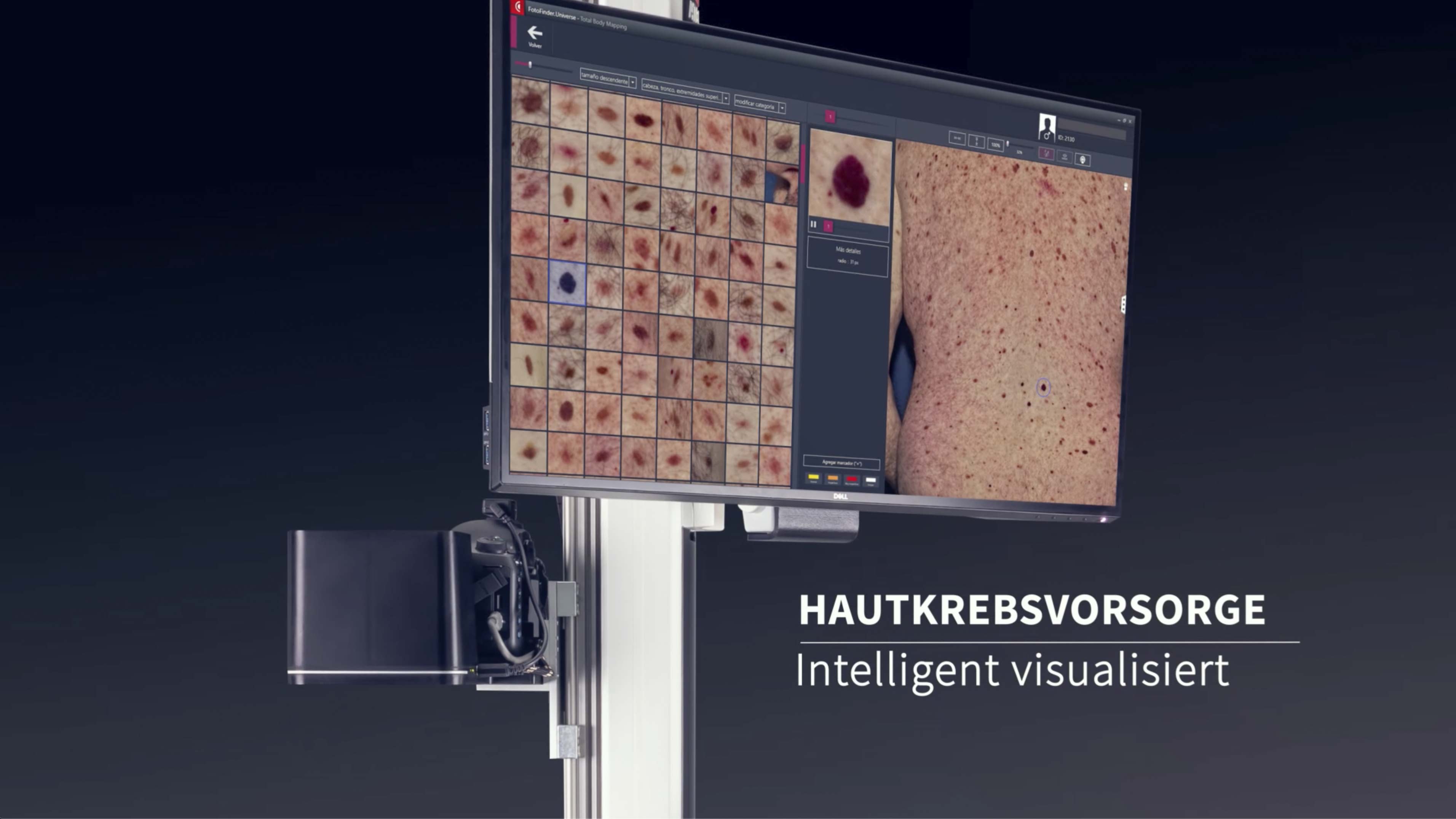 Nackt hautscreening Hautkrebsscreening